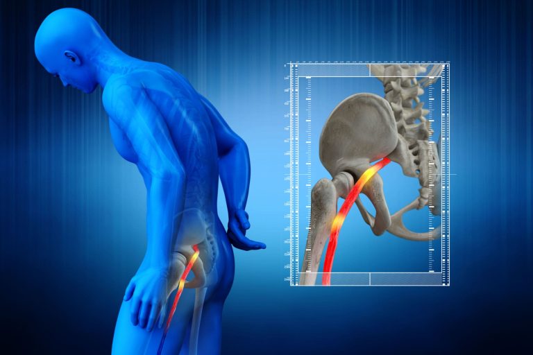 What are the symptoms of sciatica How do you treat it and how l9ng does it last