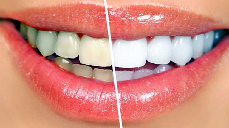 Teeth Whitening Solutions: Brilliant Ways to Brighten Your Smile